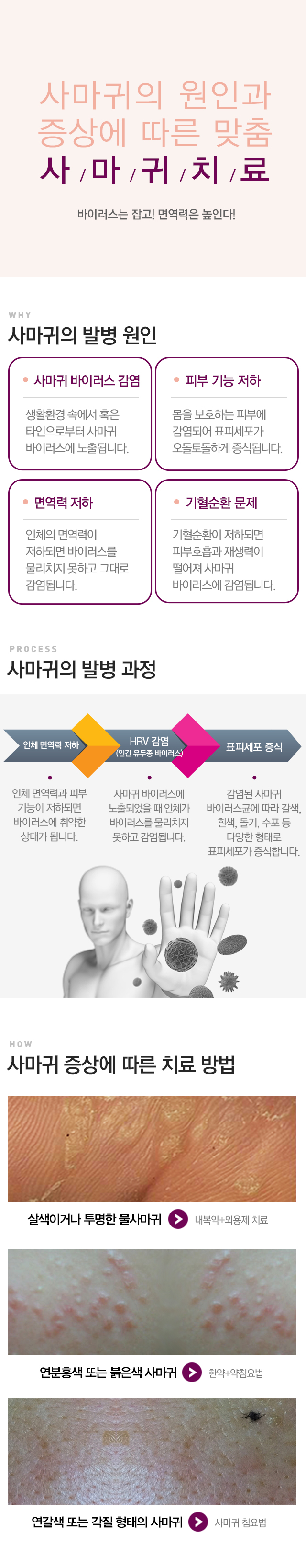 사마귀 원인